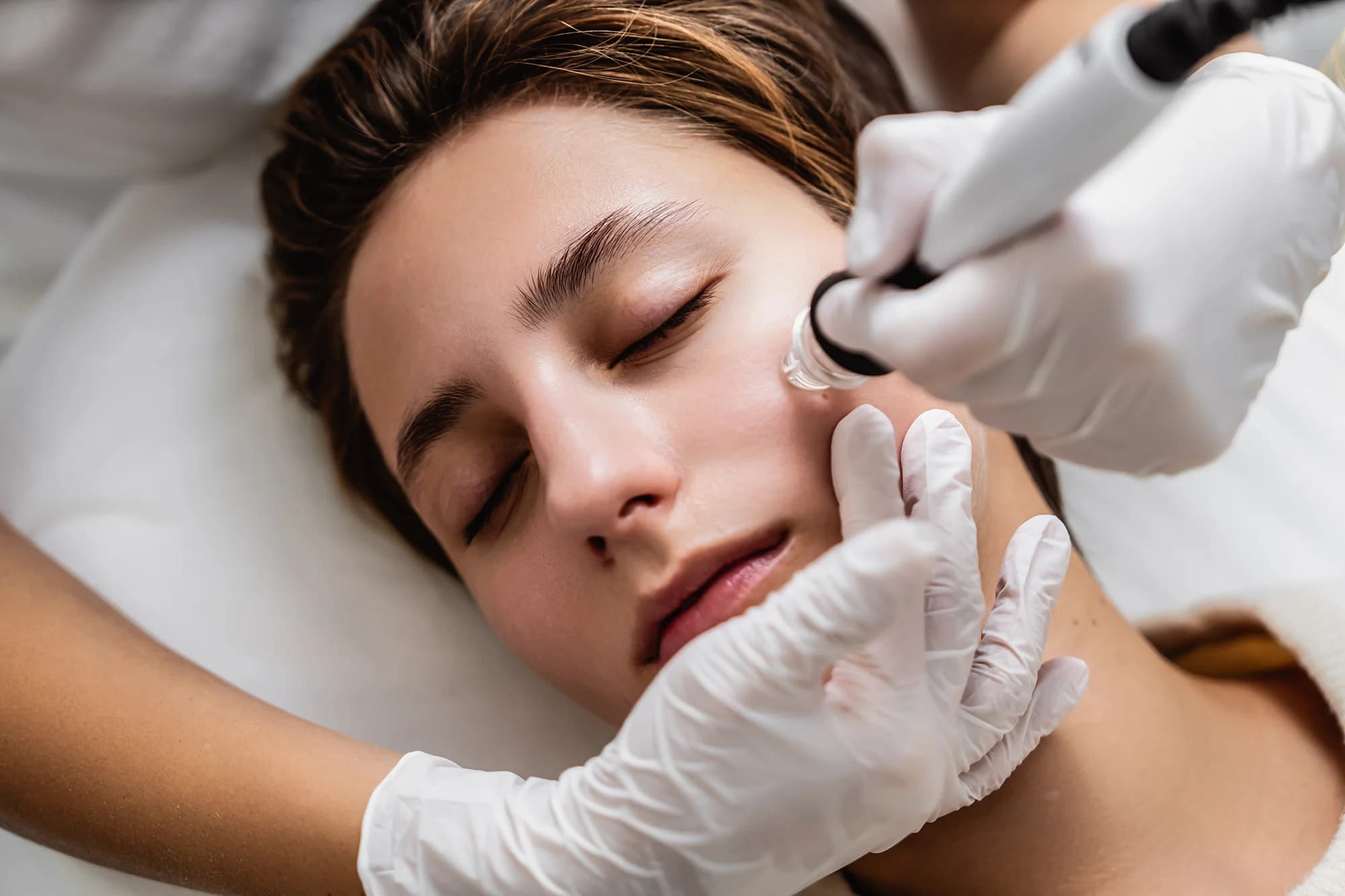 Microneedling